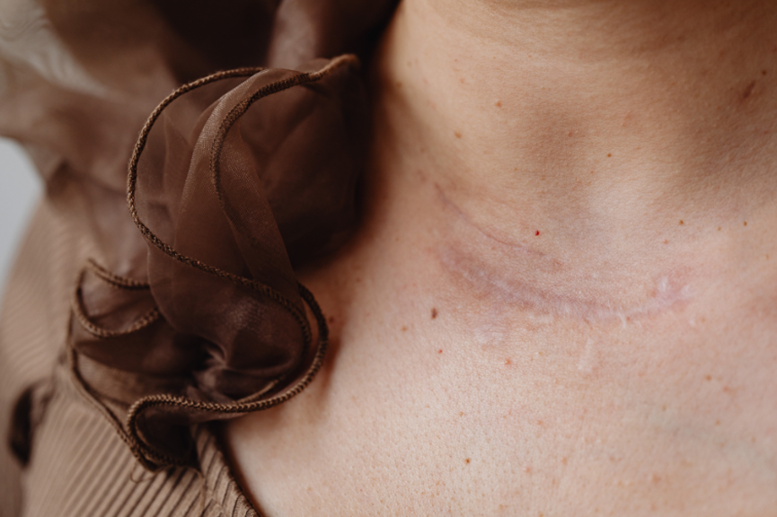 Blend Scar Therapy Blend Scar Therapy